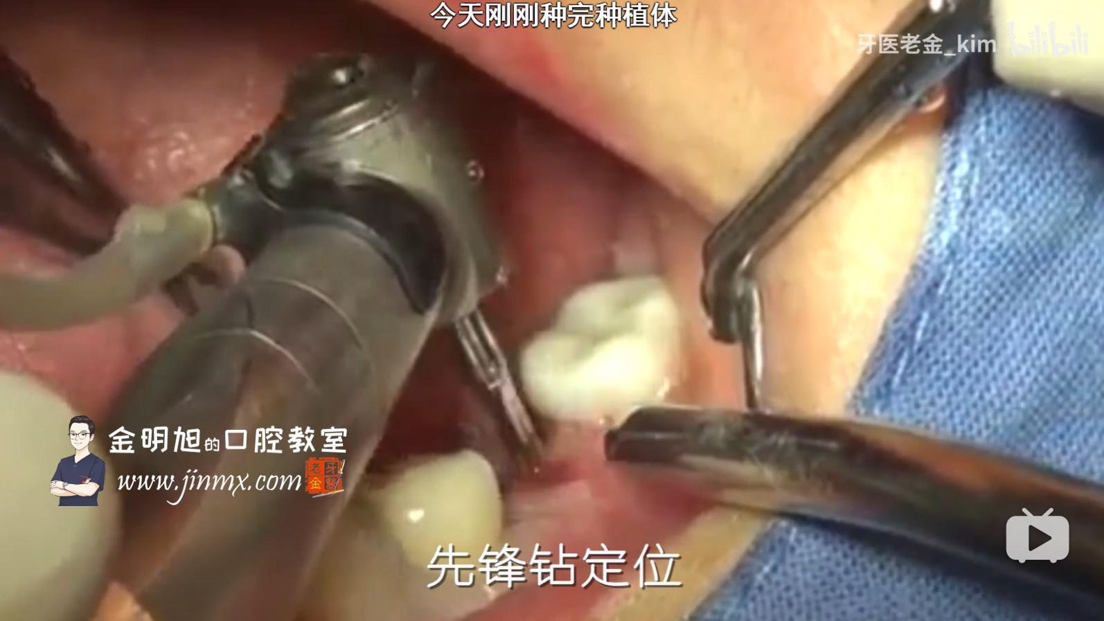 【种植牙】手术是什么体验？实拍简单种植病例